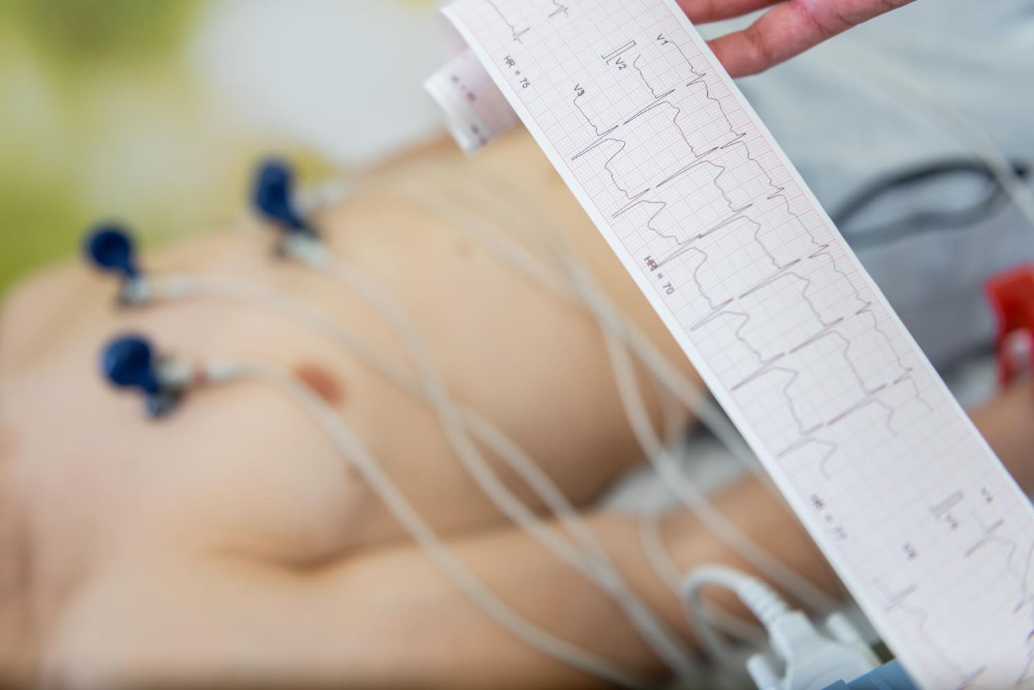 Electrocardiograma de reposo de 12 derivaciones en CDMX: Diagnóstico Cardíaco Preciso